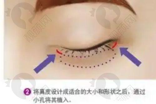 兰州时光激光整形美容医院贾治兰医生做双眼皮修复怎么样?