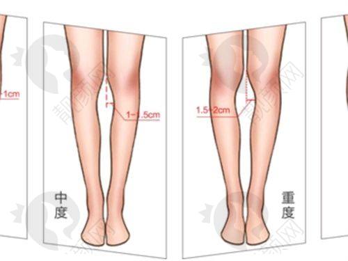 武汉天佑双眼皮怎么样?真实实例见证成效