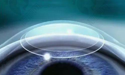 广州视献眼科靠谱吗?价格合理特别亲民