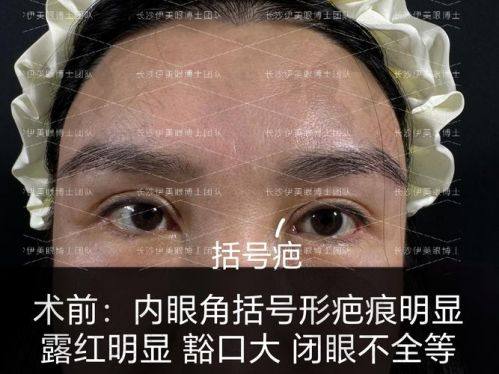 我的双眼皮修复上岸!兰州时光逯岩医生11000元全切双眼皮修复太牛啦