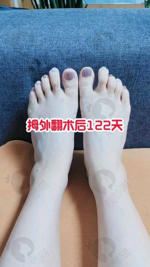 上海虹桥医院足外翻大脚骨手术:全流程的优质服务