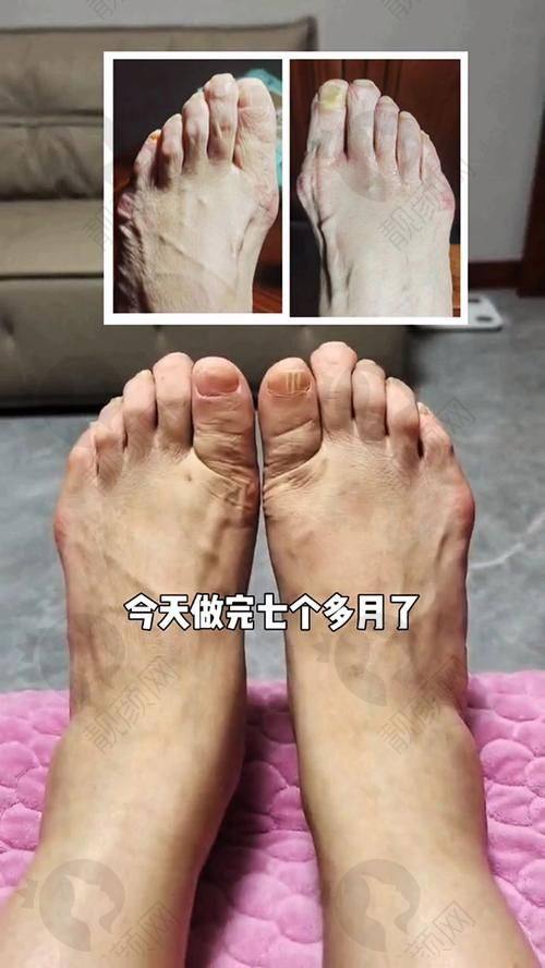 上海虹桥医院足外翻大脚骨手术:专精的医生团队保护