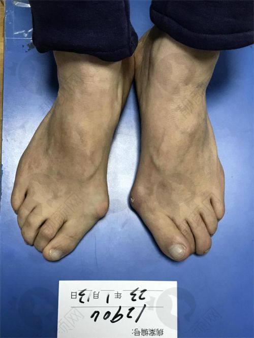 上海虹桥医院足外翻大脚骨手术:5G超微创技术的优势