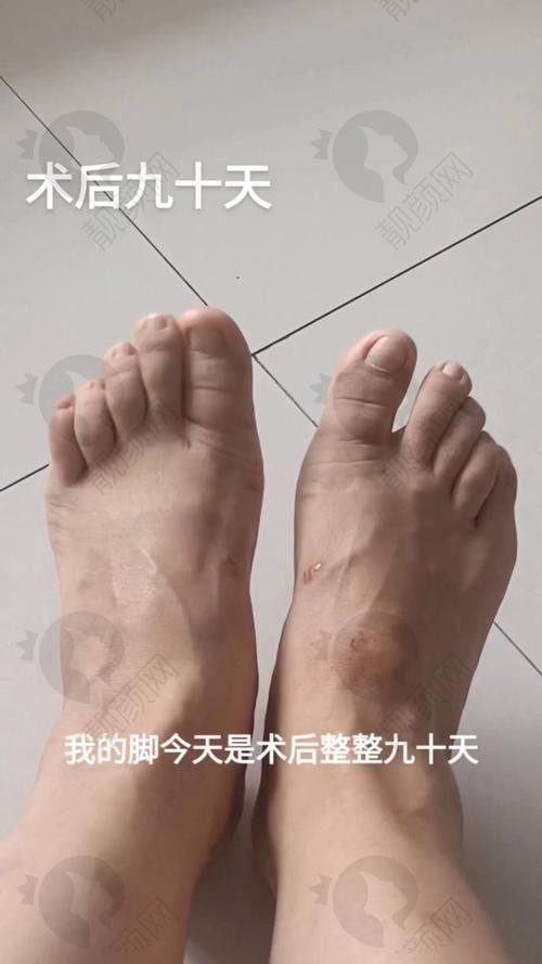 上海虹桥医院足外翻大脚骨手术:1.4万起的可靠价格