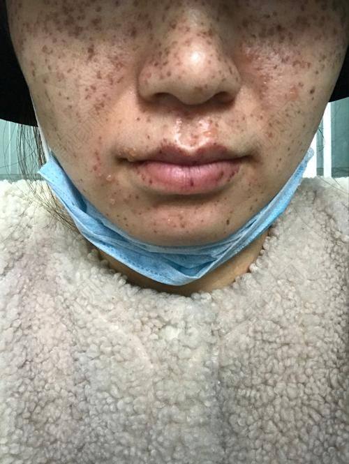 厦门祛斑哪家医院好？厦门市中医院整形科——中医特色的祛斑之路