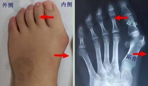 总结：放心选择告别拇外翻