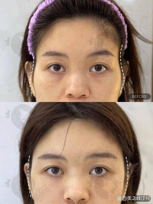上海美莱申涛医生打玻尿酸怎么样？