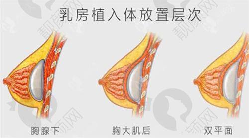 济宁韩美假体隆胸价格详情解析
