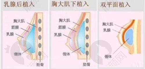 济宁韩美假体隆胸项目优势