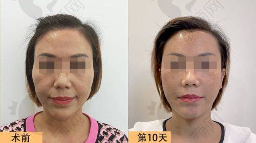 15800元的馒化脸修复过程