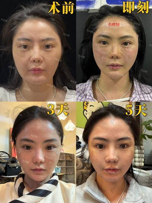 啥是馒化脸