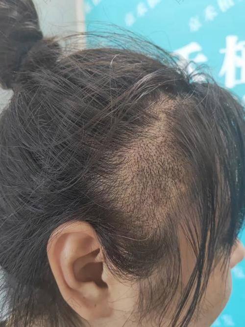 济南海峡植发医院:高国强医生领衔专精团队