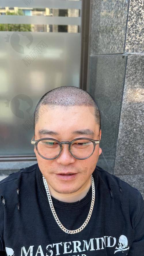济南海峡植发医院:FUE无痕植发成效超自然