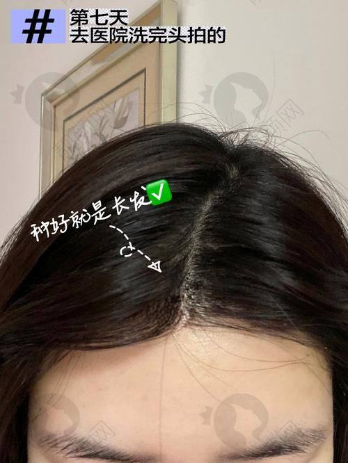 济南海峡植发医院:国内连锁的专精植发机构