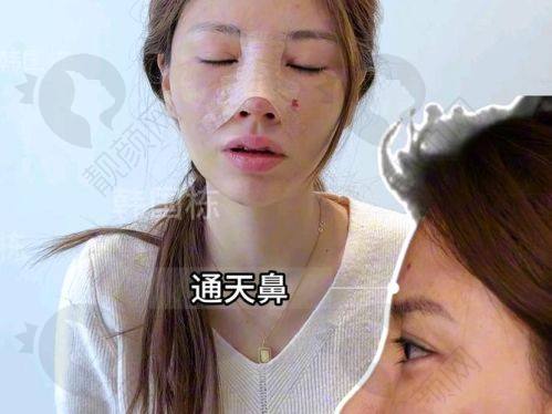 武汉硚口卓美医院隆鼻真实评价