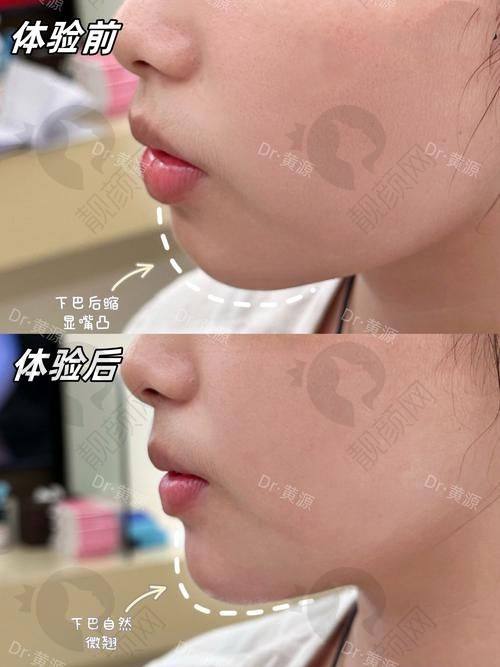 合肥下颌角削骨瘦脸费用大揭秘！技术实力对价格的影响