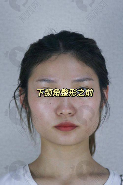合肥下颌角削骨瘦脸费用大揭秘！不同手术方式价格差异大