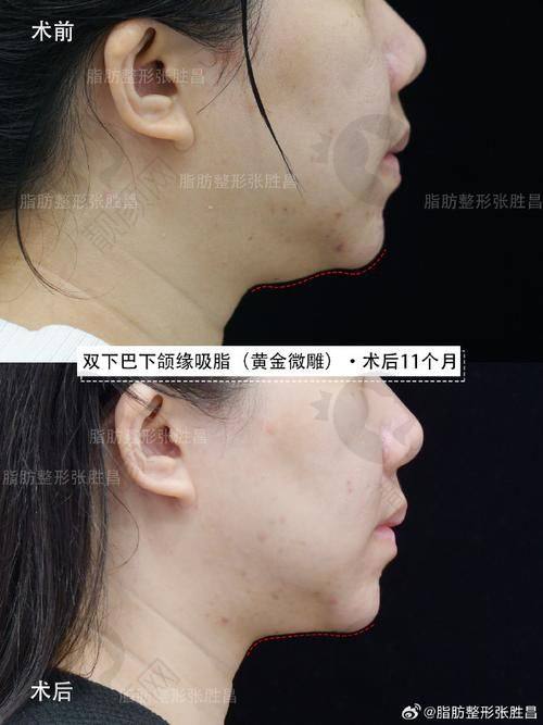 合肥下颌角削骨瘦脸费用大揭秘！好医院和医生带来的价值