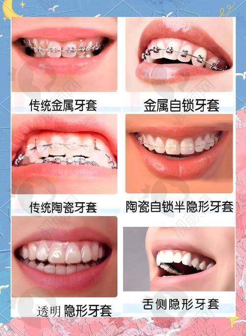 杭州泰康拜博口腔医院金属托槽牙齿矫正真实评价