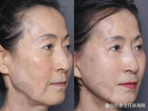 成都素美医疗美容无痕筋膜手术价格详情