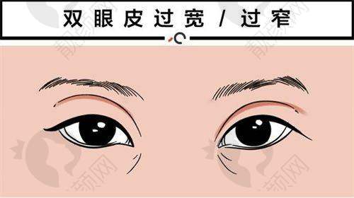 切开重睑术的介绍