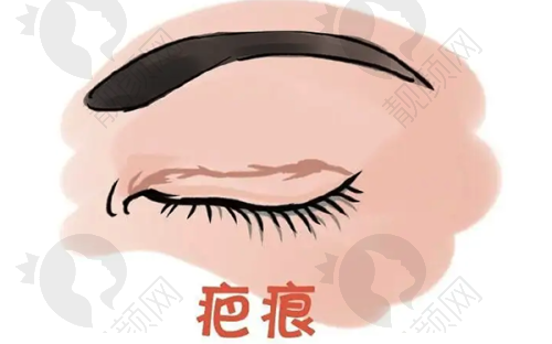 特色项目——全切双眼皮