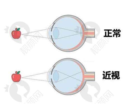 2025南宁爱尔眼科医院全飞秒优惠,性价比极高