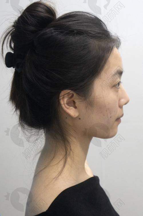 用玻尿酸垫下巴后悔了？了解后悔原因特别重要