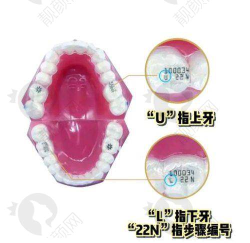 盘锦铭松博爱口腔隐适美隐形矫正具体优势