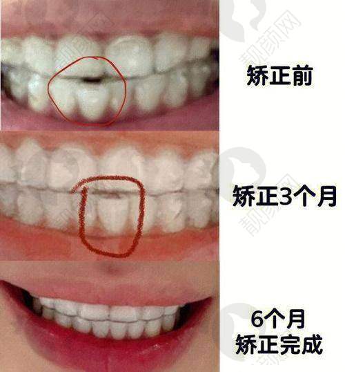 盘锦铭松博爱口腔隐适美隐形矫正医院优势总结