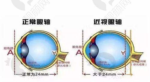 嘉兴爱尔眼科ICL晶体植入技术特点