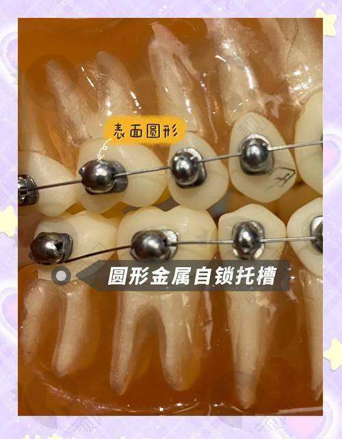 仁寿县丽齿传世口腔传统金属托槽矫正真实评价