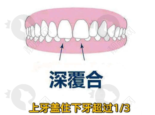 2025北碚种植牙多少钱一颗?重庆北碚贝乐嘉口腔预约须知