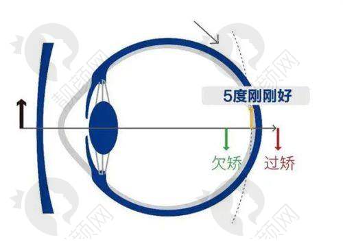 石家庄复明眼科医院全飞秒:修复快体验好