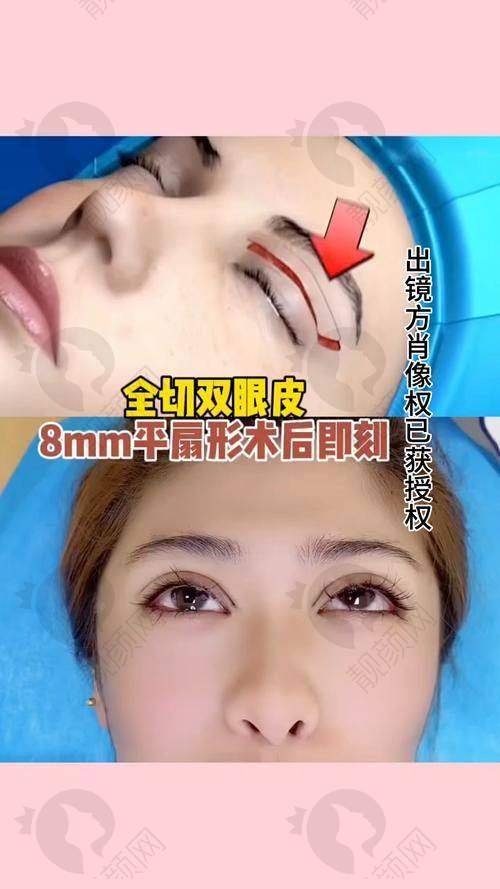 南京陈小剑双眼皮做得挺好的,2025坐镇康美,0.1mm误差技术与贴心服务获好口碑