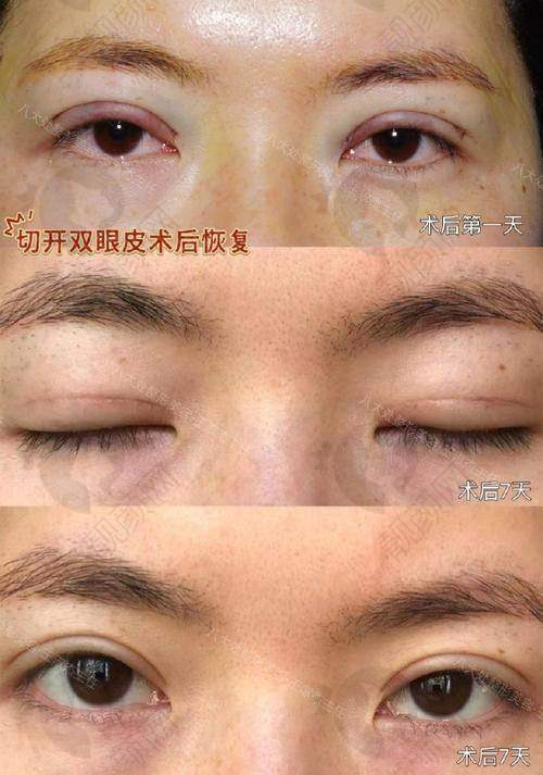 南京陈小剑双眼皮做得挺好的——常见问题解答