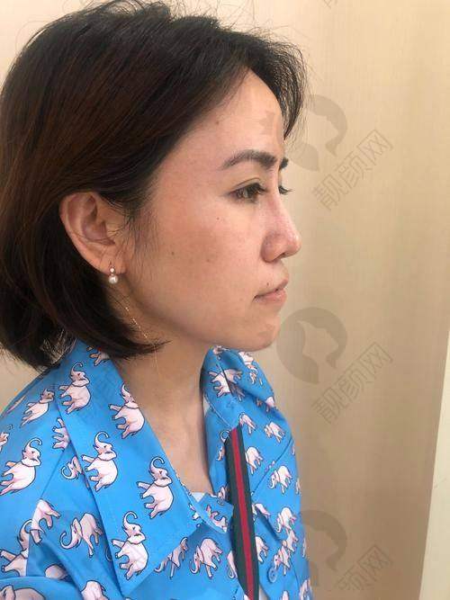 广州可玉鼻修复具体优势