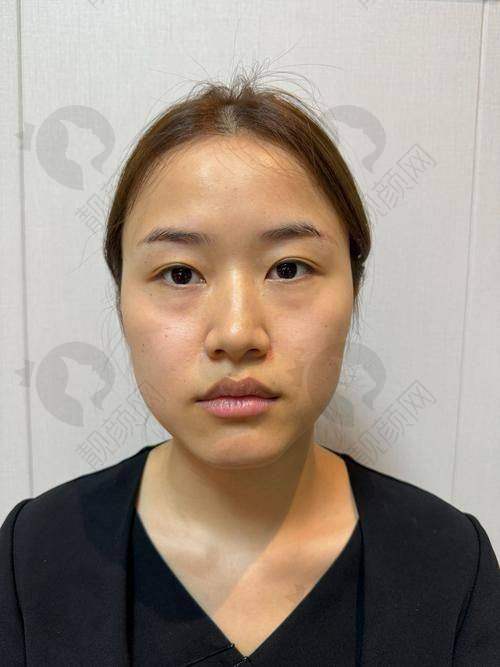 法欧曼玻尿酸：法国进口的品质保护