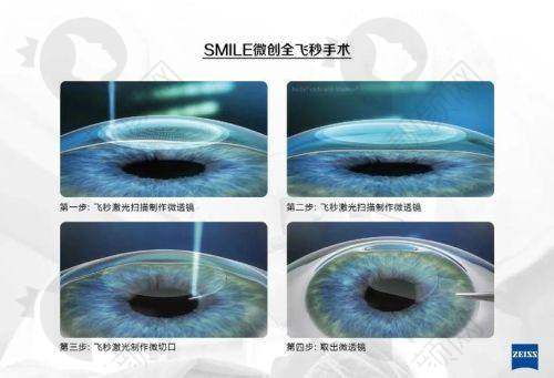 邯郸爱尔眼科医院个性化定制飞秒：技术特点