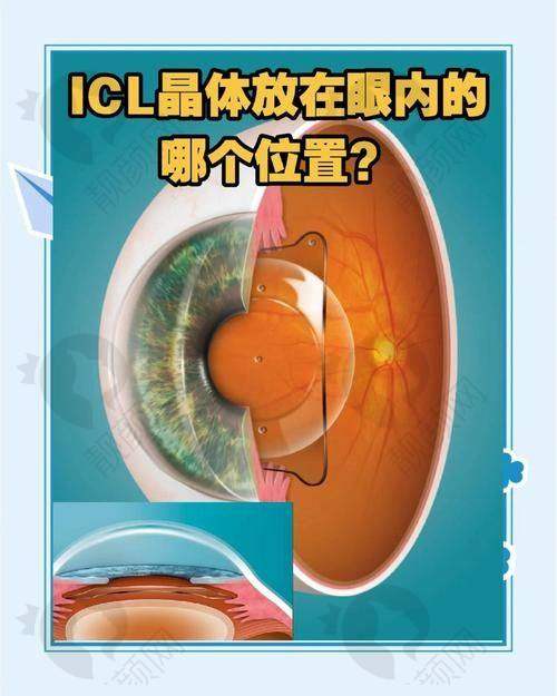 ICL近视手术技术特点：优势显著