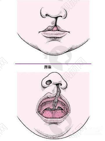 重庆松山医院唇腭裂修复医生夏德林介绍