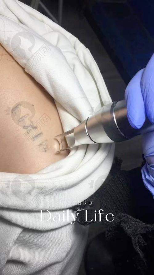 邯郸莱媚俪手臂去纹身价格详情解析