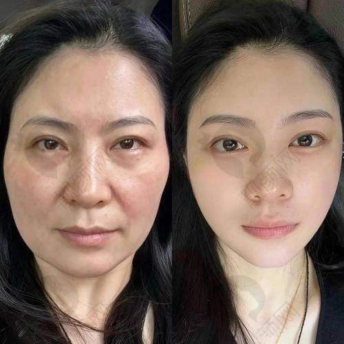2025北京面部提升好的医院排名前三揭晓：选哪家不纠结！