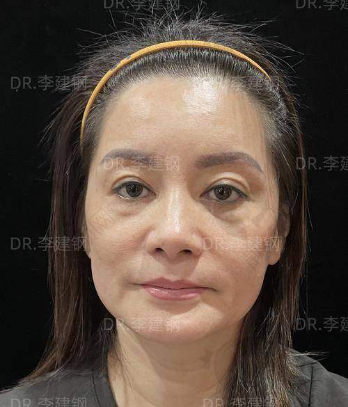 微拉美哪家医院做的好？北京加减美医疗美容，技术靠谱性价比高