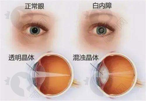 石家庄白内障手术哪个医院好？这几家地址明确、技术靠谱的医院值得考虑！