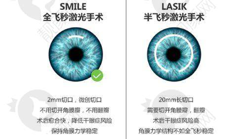 广州视百年眼科李国保做双频精细化雕刻个性化半飞秒近视手术:患者口碑良好