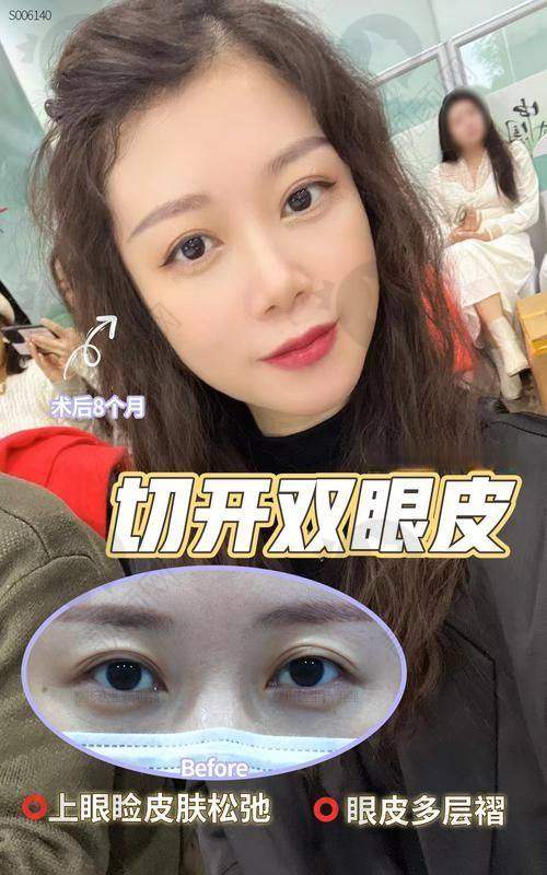 【揭秘】张伟院长：技艺不错的眼部整形大师