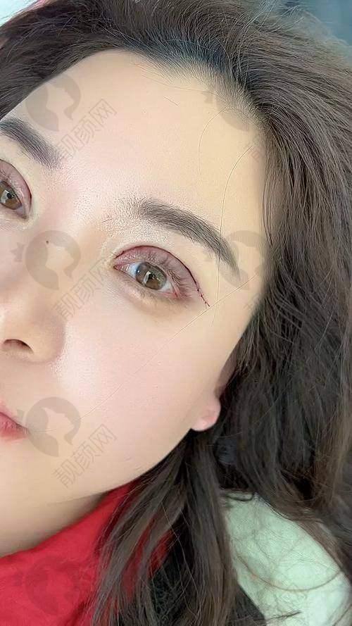 【揭秘】全切双眼皮：打造自然灵动双眼
