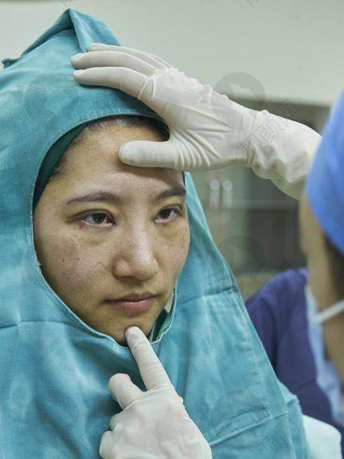上海华美陈小剑医生双眼皮失败修复和外眼角修复怎么样？