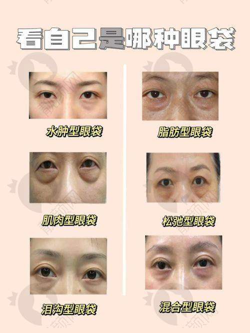 合肥福华：去除眼袋同时，让眼周更显年轻